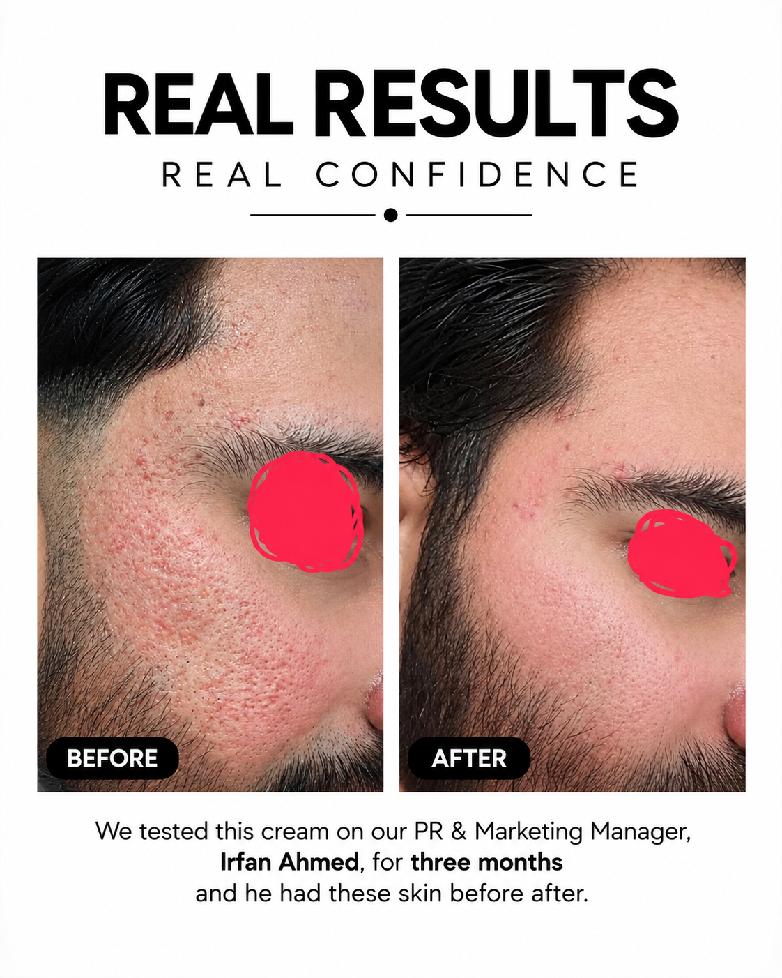 Scar Reset – Advanced Scar Recovery Cream