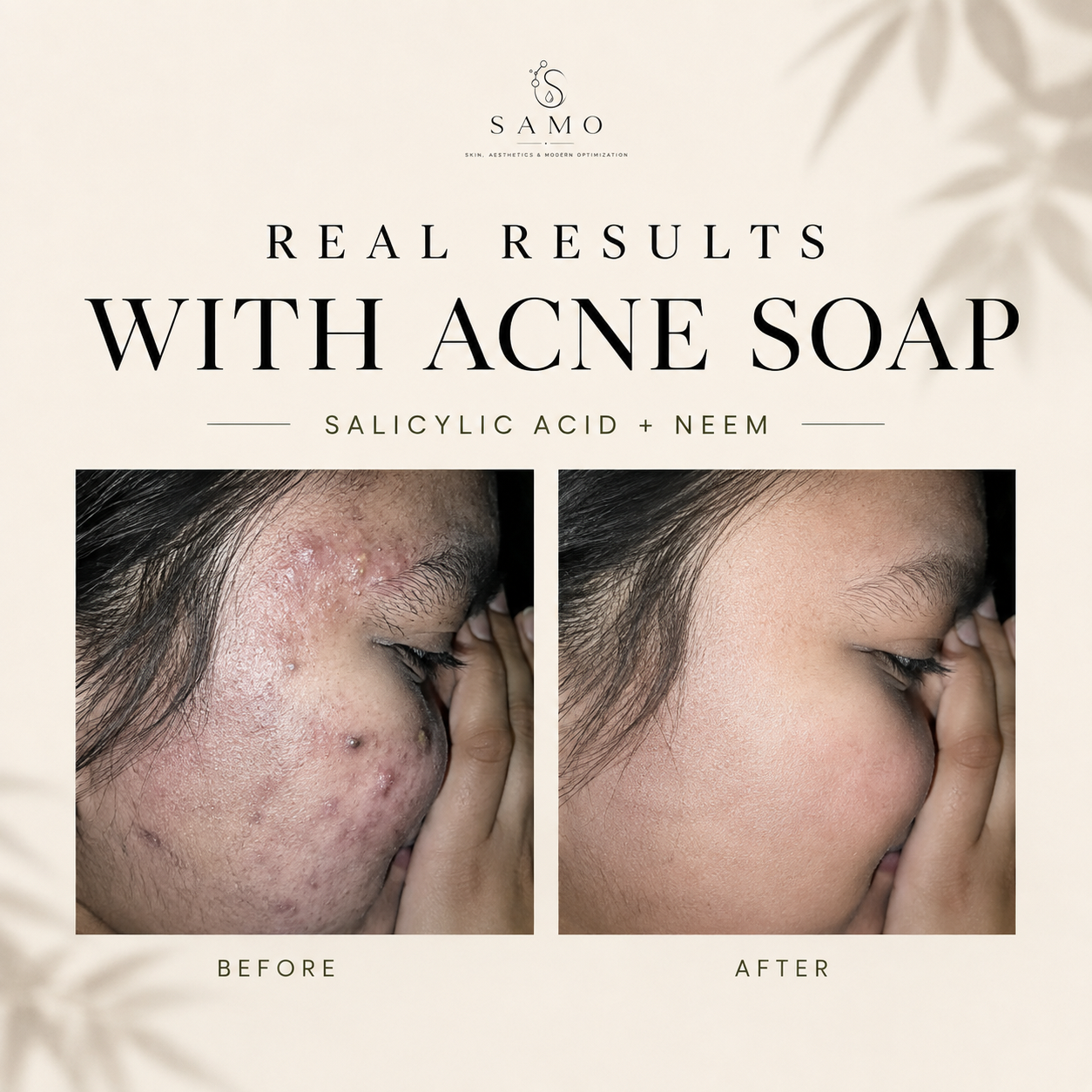 Acne Cleansing Bar